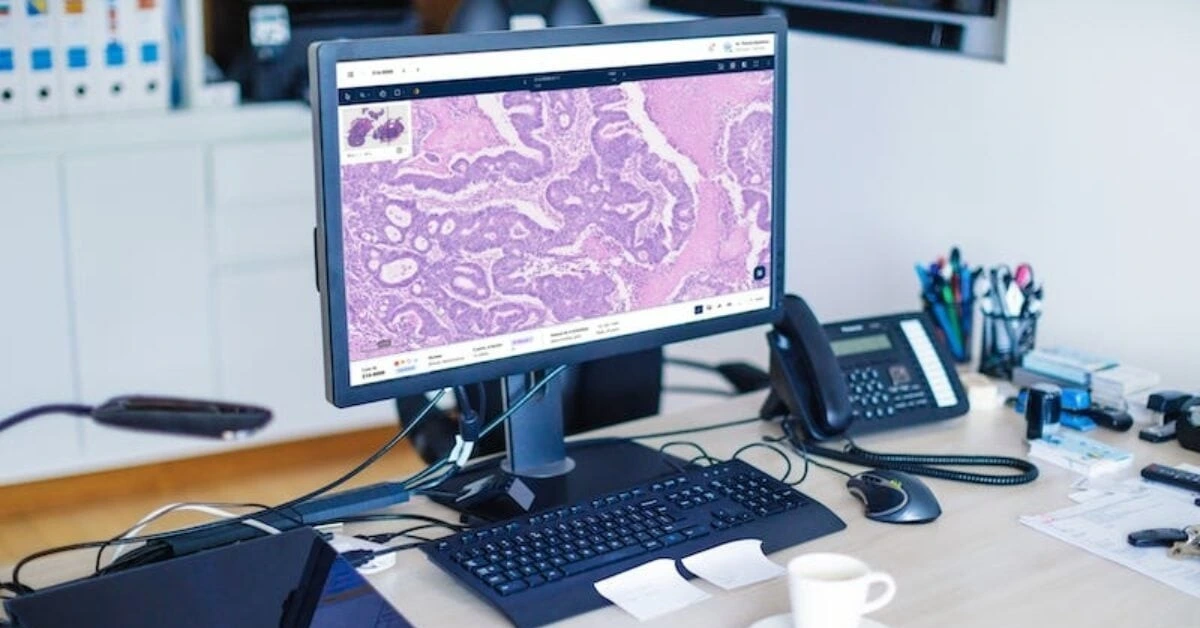 AI collaboration targets breakthrough in colorectal cancer diagnostics