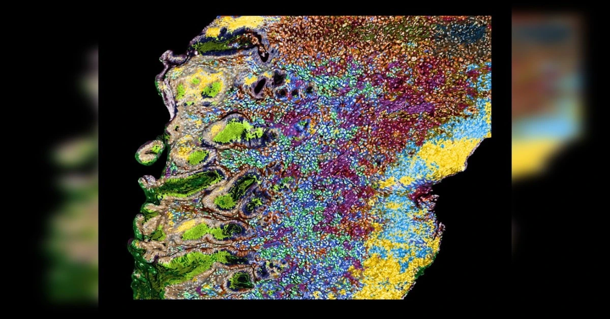 Patho-DBiT image Patho-DBiT reveals cellular level tissue architecture of an aggressive gastric lymphoma sample stored for 3 years.