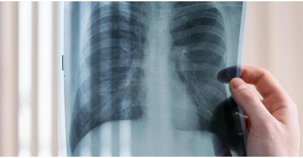 PenRAD Imaging Network adopts AI to enhance early lung cancer detection