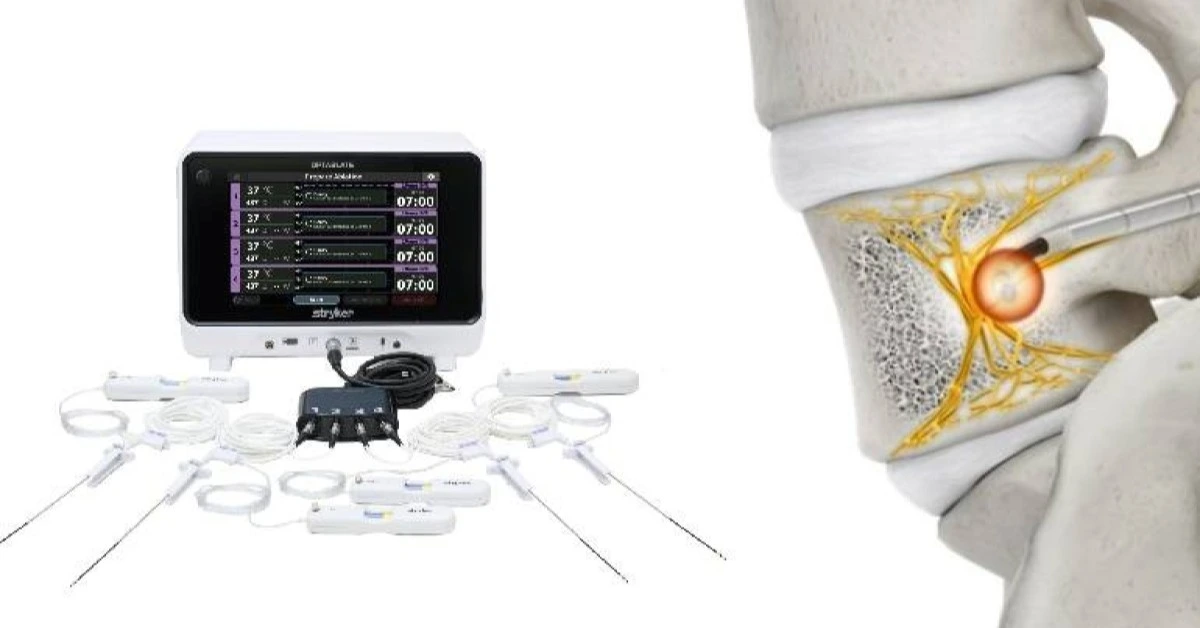 FDA clears Stryker’s OptaBlate for chronic back pain