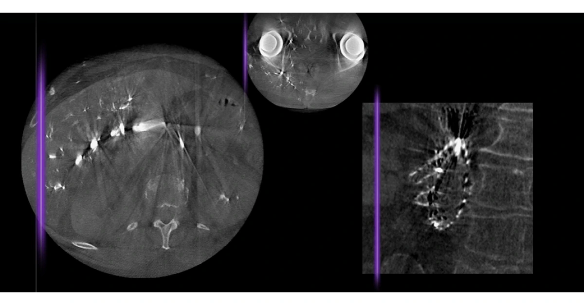 GE unveils CleaRecon DL for sharper CBCT images
